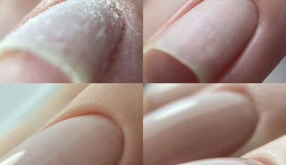 Alignment of the nail plate