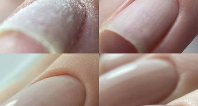 Alignment of the nail plate